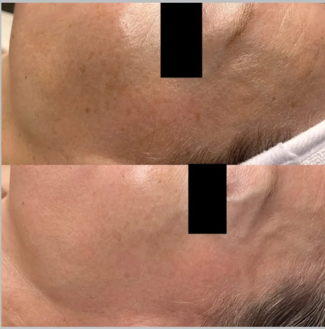 @morgan.kulbeck with the stunning before and after from 1 @sciton_inc BBL 😍💡⚡️ ⁣
⁣
* This patients treatment plan involves a series of 3. ⁣
⁣
* This service is available at our Helena, Bozeman, and Missoula locations. ⁣